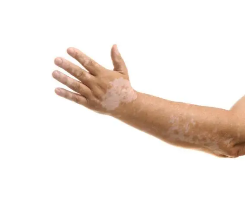 疑难杂症信息网|www.ynzzxxw.com告别白癜风，让你不再为白癜风苦恼——《豐瑜祛白归元药酒》